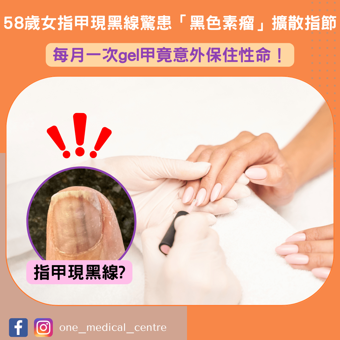 【58歲女指甲現黑線驚患「黑色素瘤」擴散指節　靠gel甲保住1命】